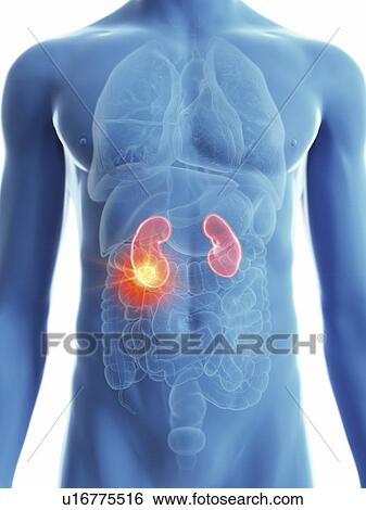 Stock Photograph - Illustration of a man's kidney cancer.. Fotosearch