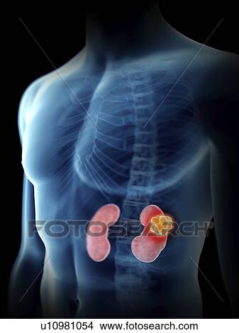 Picture - Illustration of a man's kidney.. Fotosearch