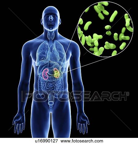 Stock Photo - Illustration of a man's kidney infection.. Fotosearch