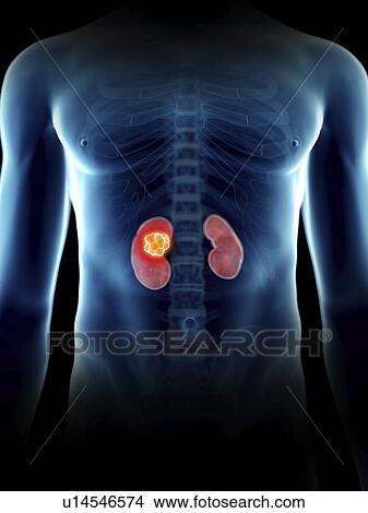 Picture - Illustration of a man's kidney tumour.. Fotosearch