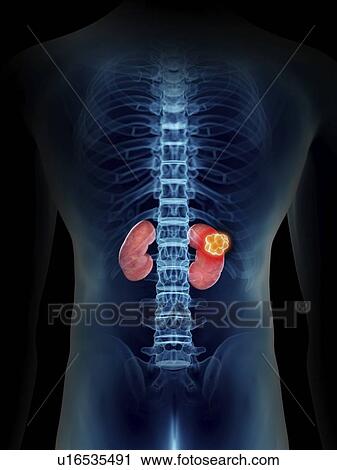 Illustration of a man's kidney tumour. View Large Photo Image Stock Image - Illustration of a man's kidney tumour.. Fotosearch
