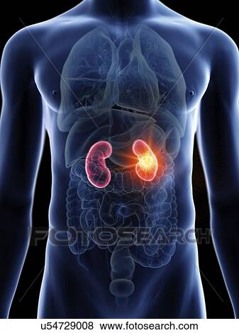 Stock Photo - Illustration of a man's kidneys cancer.. Fotosearch