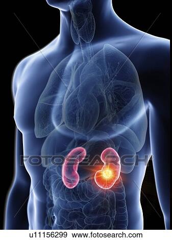 Stock Photo - Illustration of a man's kidneys tumour.. Fotosearch