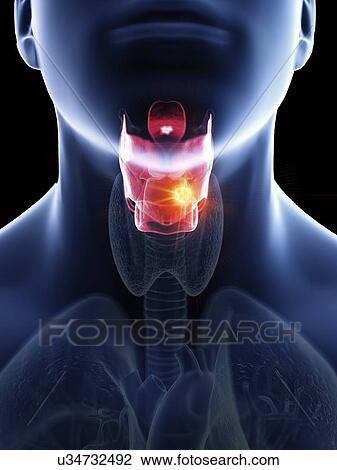 Illustration of a man's larynx cancer. View Large Photo Image Stock Image - Illustration of a man's larynx cancer.. Fotosearch