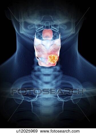 Stock Photo - Illustration of a man's larynx tumour.. Fotosearch