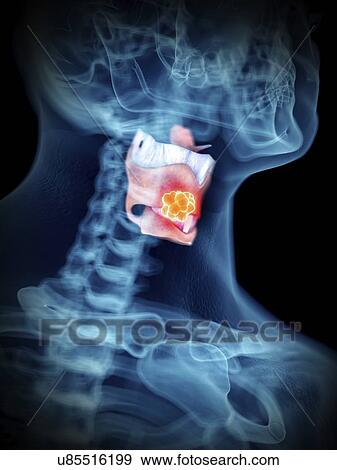 Illustration of a man's larynx tumour. View Large Photo Image Stock Photo - Illustration of a man's larynx tumour.. Fotosearch