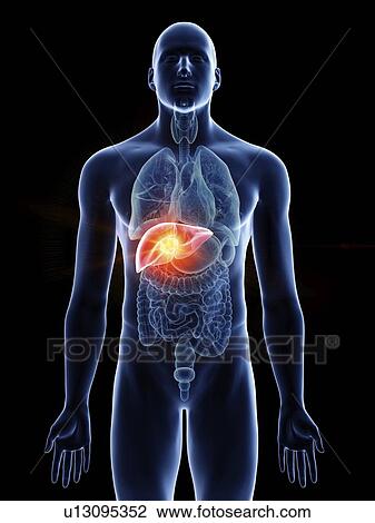 Stock Image - Illustration of a man's liver cancer.. Fotosearch