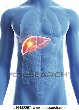 Stock Photo - Illustration of a man's liver cancer.. Fotosearch