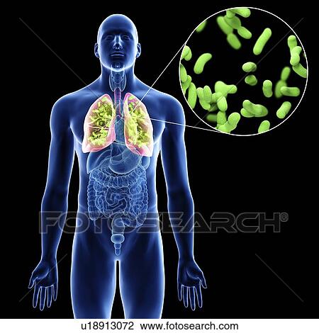 Illustration of a man's lung infection. View Large Photo Image Stock Image - Illustration of a man's lung infection.. Fotosearch