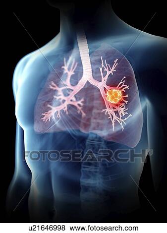 Stock Photo - Illustration of a man's lung tumour.. Fotosearch