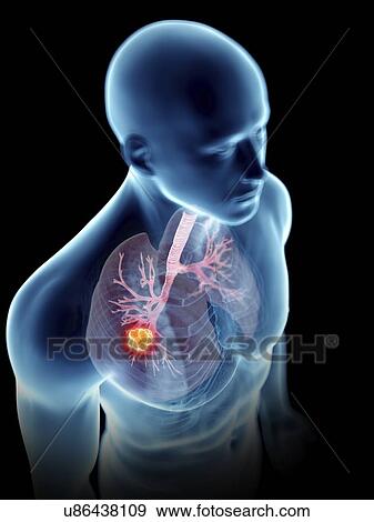Illustration of a man's lung tumour. View Large Photo Image Stock Photo - Illustration of a man's lung tumour.. Fotosearch