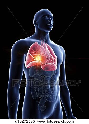 Illustration of a man's lung tumour. View Large Photo Image Stock Photography - Illustration of a man's lung tumour.. Fotosearch