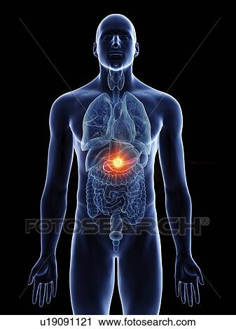 Stock Image - Illustration of a man's pancreas cancer.. Fotosearch