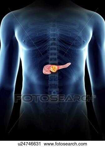 Stock Image - Illustration of a man's pancreas tumour.. Fotosearch