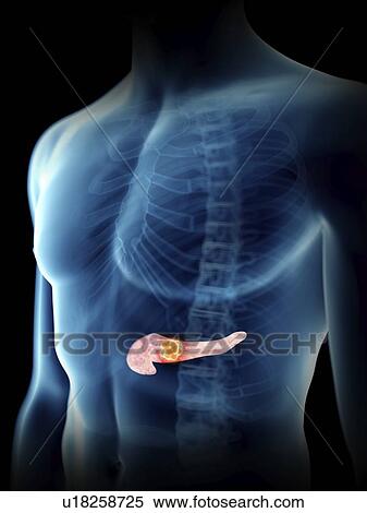 Stock Photography - Illustration of a man's pancreas tumour.. Fotosearch