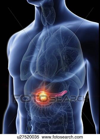 Stock Photography - Illustration of a man's pancreas tumour.. Fotosearch