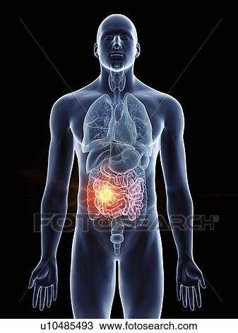 Illustration of a man's small intestine cancer. View Large Photo Image Stock Image - Illustration of a man's small intestine cancer.. Fotosearch