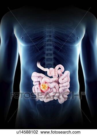 Stock Image - Illustration of a man's small intestine tumour.. Fotosearch