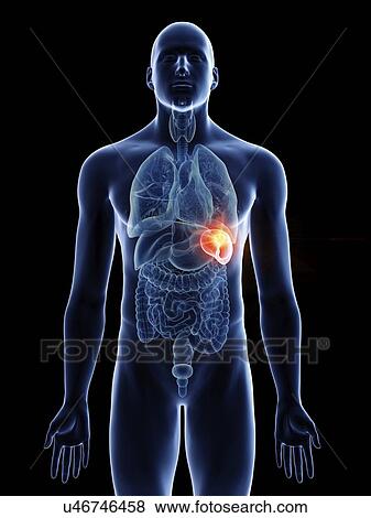 Stock Photo - Illustration of a man's spleen cancer.. Fotosearch