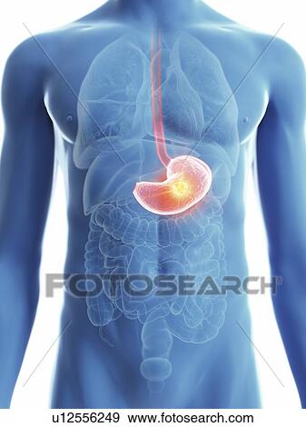 Stock Photo - Illustration of a man's stomach cancer.. Fotosearch