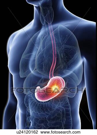Illustration of a man's stomach tumour. View Large Photo Image Stock Image - Illustration of a man's stomach tumour.. Fotosearch