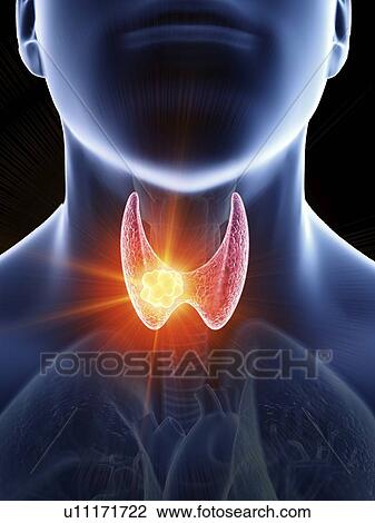 Stock Image - Illustration of a man's thyroid gland cancer.. Fotosearch
