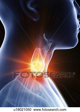 Stock Image - Illustration of a man's thyroid gland cancer.. Fotosearch