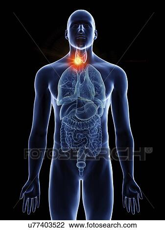 Stock Image - Illustration of a man's thyroid gland cancer.. Fotosearch