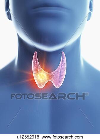 Stock Photo - Illustration of a man's thyroid gland cancer.. Fotosearch