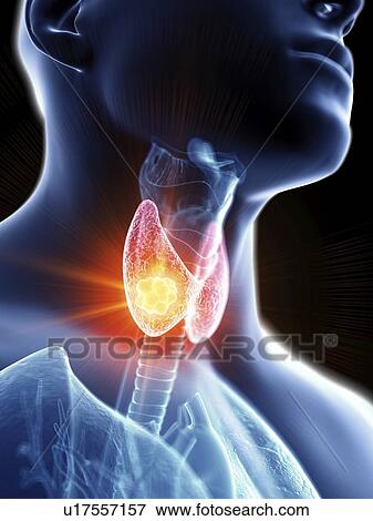 Illustration of a man's thyroid gland cancer. View Large Photo Image Stock Photo - Illustration of a man's thyroid gland cancer.. Fotosearch