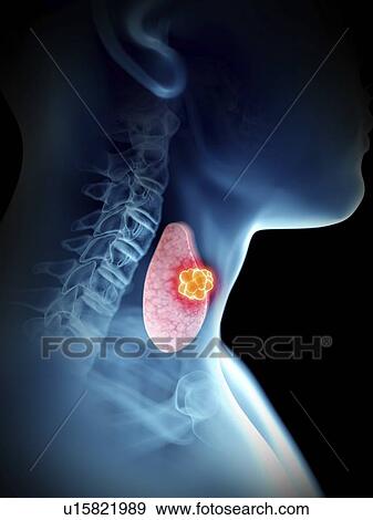 Illustration of a man's thyroid tumour. View Large Photo Image Stock Photo - Illustration of a man's thyroid tumour.. Fotosearch