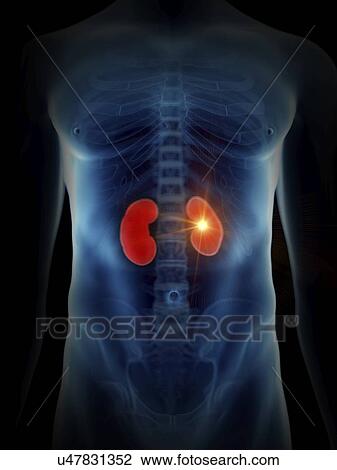 Illustration of a painful kidney. View Large Photo Image Stock Image - Illustration of a painful kidney.. Fotosearch