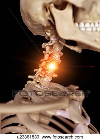Illustration of a painful neck. View Large Photo Image Stock Photo - Illustration of a painful neck.. Fotosearch