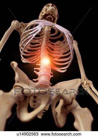 Illustration of a painful spine. View Large Photo Image Stock Image - Illustration of a painful spine.. Fotosearch
