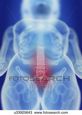 Illustration of a painful spine. View Large Photo Image Stock Image - Illustration of a painful spine.. Fotosearch