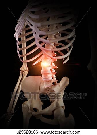 Stock Photograph - Illustration of a painful spine.. Fotosearch