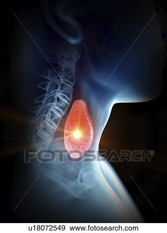 Stock Photo - Illustration of a painful thyroid gland.. Fotosearch