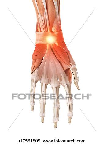 Stock Photo - Illustration of a painful wrist.. Fotosearch