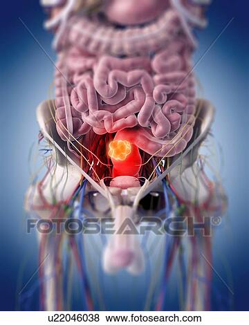 Stock Photo - Illustration of a rectal tumour.. Fotosearch