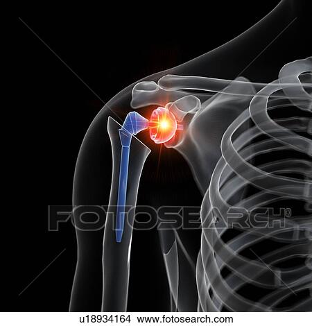 Illustration of a shoulder replacement. View Large Photo Image Picture - Illustration of a shoulder replacement.. Fotosearch