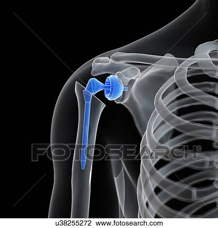 Stock Image - Illustration of a shoulder replacement.. Fotosearch