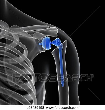 Stock Photo - Illustration of a shoulder replacement.. Fotosearch