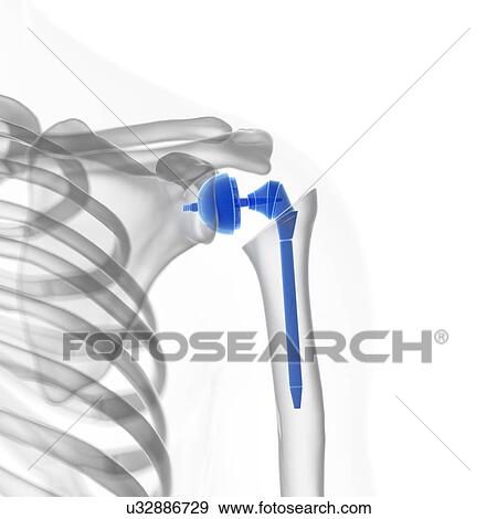 Illustration of a shoulder replacement. View Large Photo Image Stock Photo - Illustration of a shoulder replacement.. Fotosearch