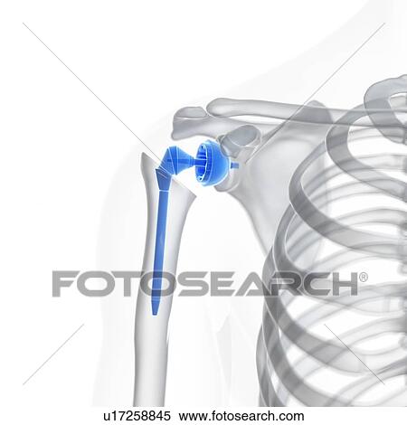 Stock Photography - Illustration of a shoulder replacement.. Fotosearch