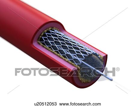 Stock Image - Illustration of a stent in action.. Fotosearch