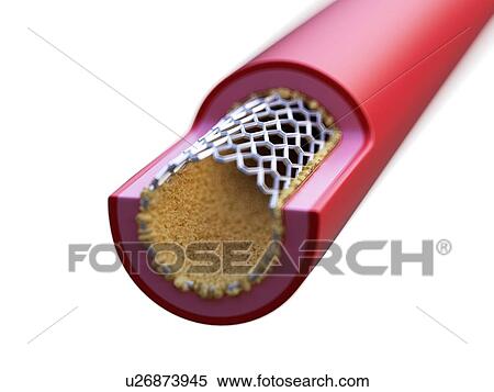 Stock Photography - Illustration of a stent in action.. Fotosearch