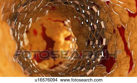 Illustration of a stent inside of a fatty artery. View Large Photo Image Picture - Illustration of a stent inside of a fatty artery.. Fotosearch
