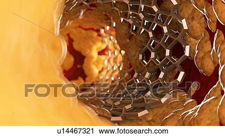 Illustration of a stent inside of a fatty artery. View Large Photo Image Stock Image - Illustration of a stent inside of a fatty artery.. Fotosearch