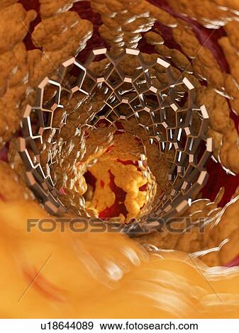 Stock Photo - Illustration of a stent inside of a fatty artery.. Fotosearch