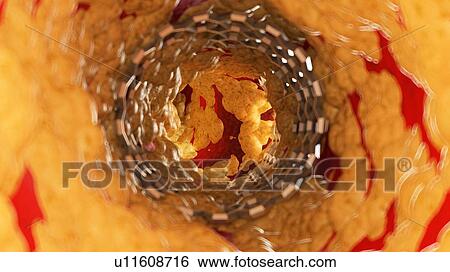 Illustration of a stent inside of a fatty artery. View Large Photo Image Stock Photograph - Illustration of a stent inside of a fatty artery.. Fotosearch